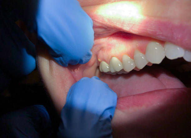 Best Emergency Tooth Extraction in Hephzibah, GA