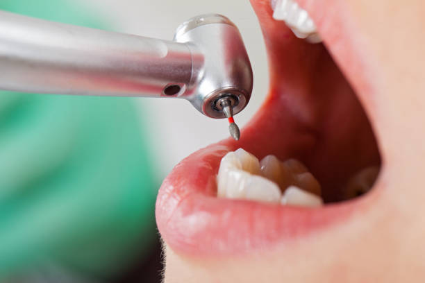 Best Emergency Tooth Extraction in Hephzibah, GA